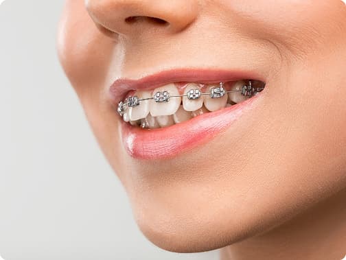 Braces Treatment