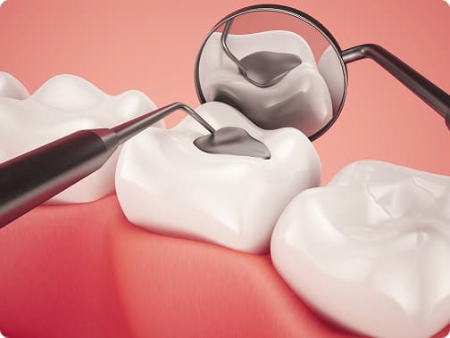 Dental Fillings Treatment