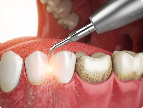 Dental Oral Cleaning